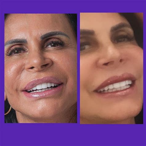 labioplastia antes e depois